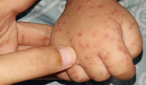 Kondisi tangan pasien flu Singapura