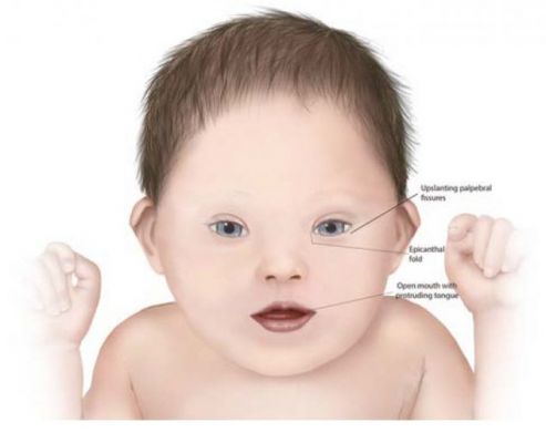 Gambar Mata Harimau Down Syndrome