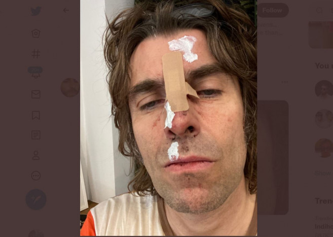 Liam Gallagher Mengaku Cedera karena Jatuh dari Helikopter