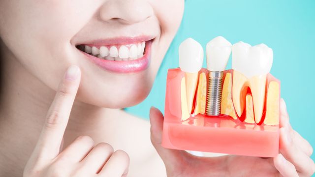 Hati-Hati, Pemasangan Implan Gigi Perlu Sertifikasi Khusus