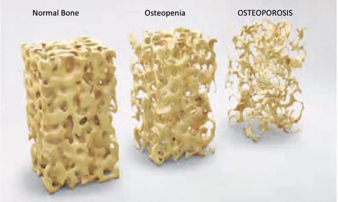 Duh, Malas Gerak Selama Pandemi Bisa Kena Osteoporosis