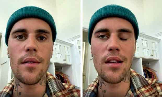 Bieber Dilaporkan Tunjukkan Tanda-Tanda Pemulihan Awal