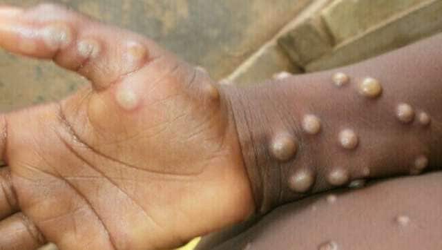Mengenal Apa Gejala dan Cara Pencegahan Monkeypox