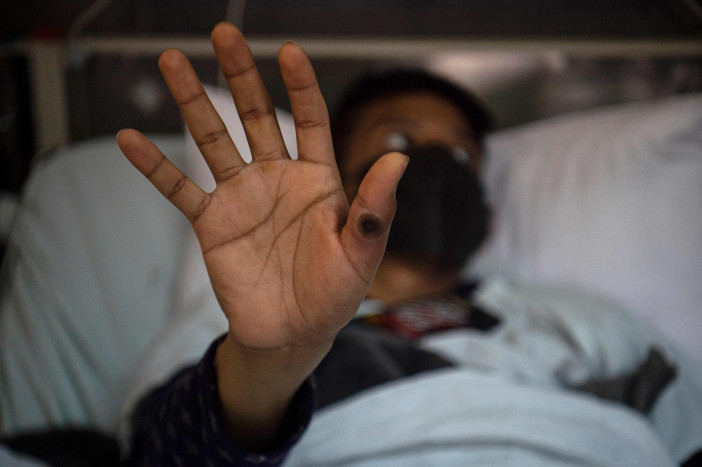 Satgas: Pemeriksaan Sifilis Bisa Dilakukan pada Suspect Monkeypox
