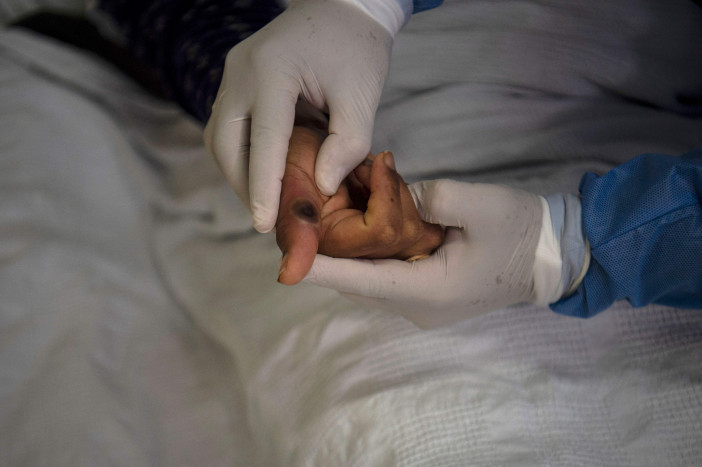 Satu Pasien Monkeypox di Indonesia Dinyatakan Sembuh