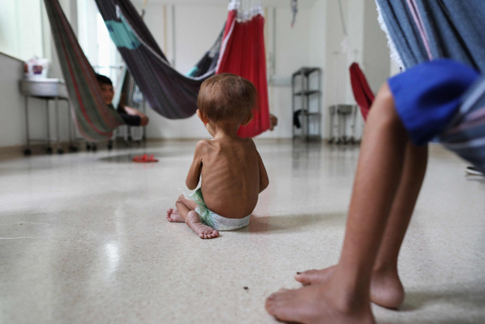 Alami Gizi Buruk, Anak-anak Suku Asli Amazon Dirawat di Rumah Sakit
