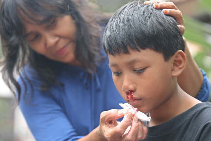 Jangan Panik, Ini yang Bisa Dilakukan saat Mimisan