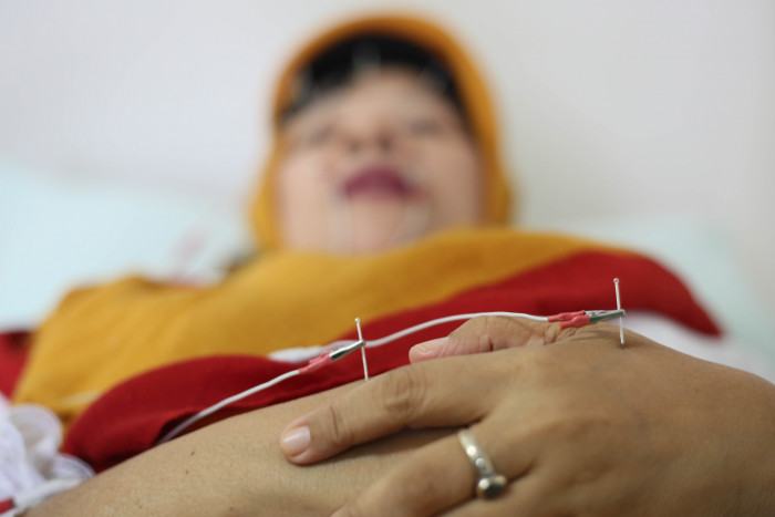 Akupuntur Diklaim Bisa Mengurangi Efek Samping Terapi Pasien Kanker