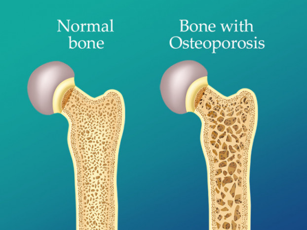 Penderita Asma Lebih Berisiko Alami Osteoporosis