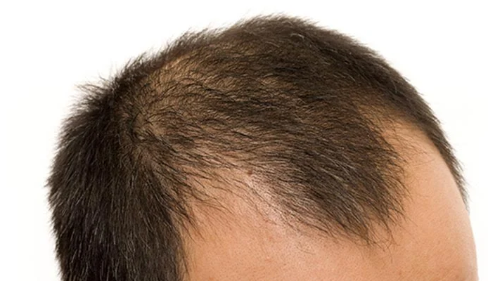 13 Cara Alami Mengatasi Rambut Rontok dan Kebotakan