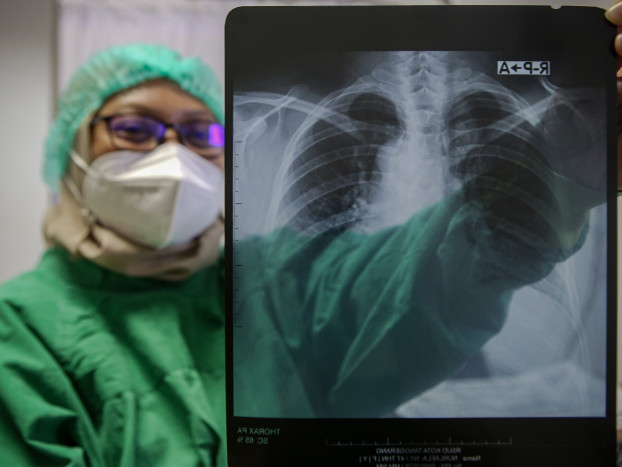 Kasus TB Meningkat, Deteksi Dini Harus Diperluas