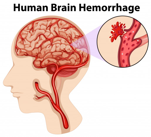 Cak Nun Alami Pendarahan Otak, Kenali 9 Gejala dan 8 Penyebabnya