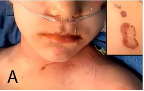 Sekujur Tubuh Gadis di Tegal Melepuh karena Sindrom Langka Staphylococcal Scalded Skin