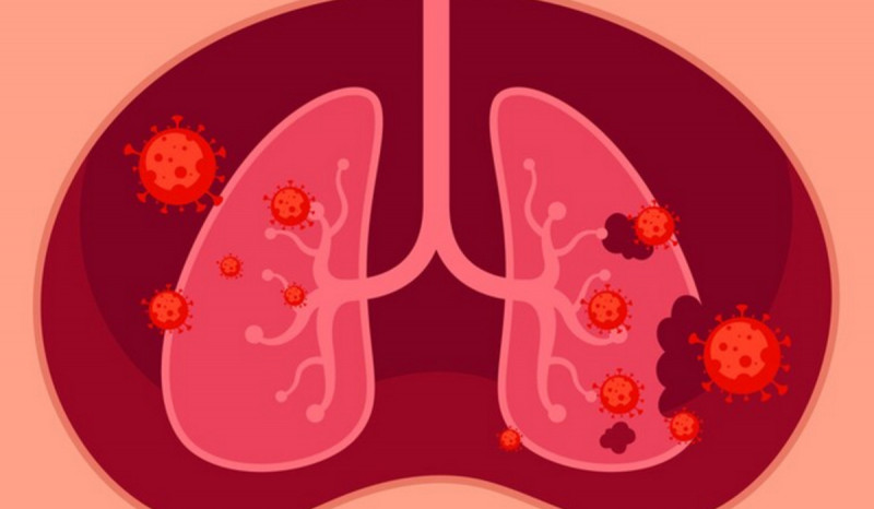 Dua Kasus Mycoplasma Pneumonia seperti di Tiongkok Ditemukan di Medan