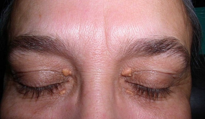 Dokter Pastikan Xanthelasma Terjadi karena Kolesterol