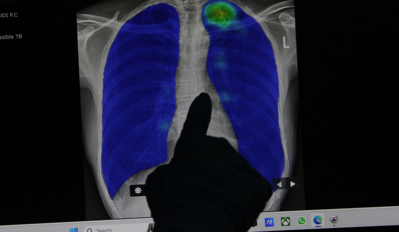 Tuberkulosis di Indonesia Diestimasikan Tembus 1 Juta Kasus