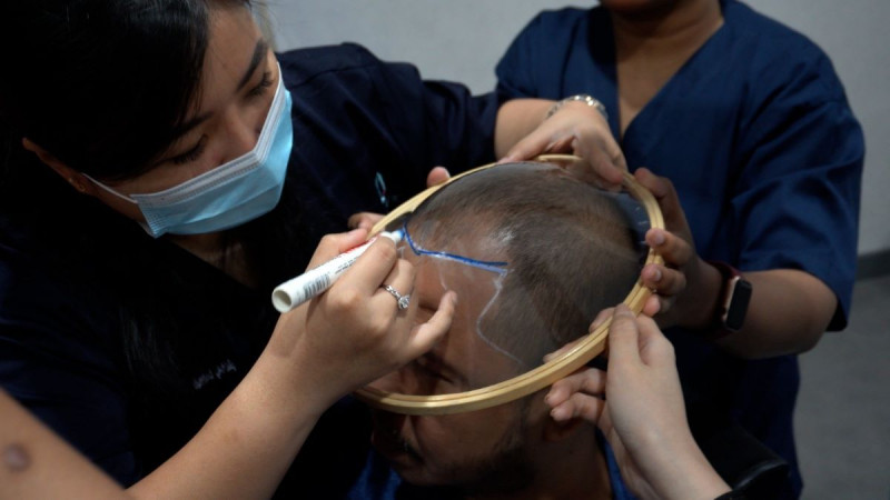 Transplantasi Rambut tidak Perlu Jauh ke Turki