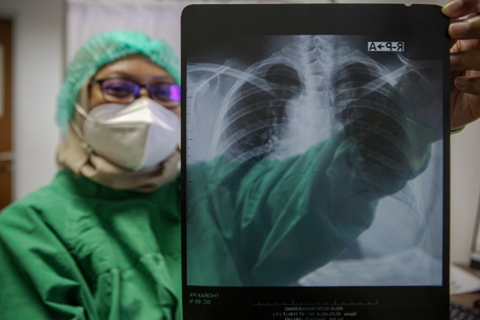 Terobosan Baru dalam Perang Melawan Tuberkulosis Resisten Obat di Asia-Pasifik