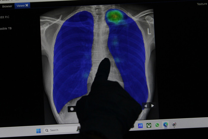 Angka kematian Tuberkulosis India Menurun, Indonesia Harus Belajar