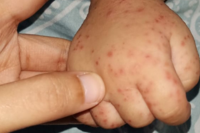 Diduga Terserang Flu Singapura, Sejumlah Warga di Semarang Khawatir