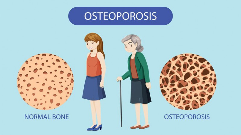 Perempuan Berisiko Osteoporosis, Cek dengan Pemeriksaaan Kepadatan Mineral Tulang